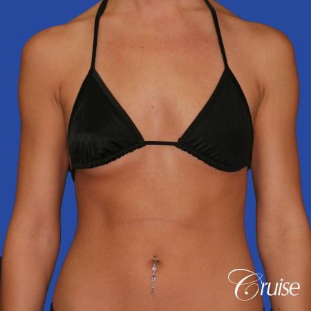 Breast Augmentation - Before and After Image 4