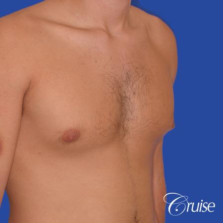 24 yr old body builder mild gynecomastia - Before and After Image 3