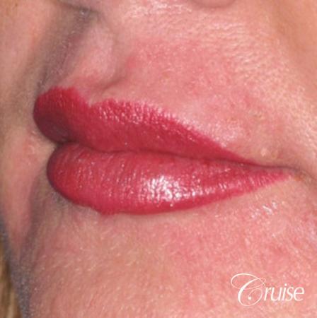 best filler pictures in Newport Beach - After Image 2