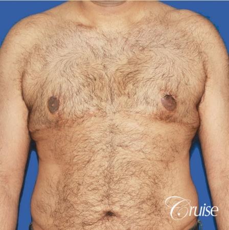 40 year old with severe gynecomastia results - After Image 1