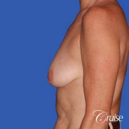 best breast lift donut pictures on mature woman - Before Image 2
