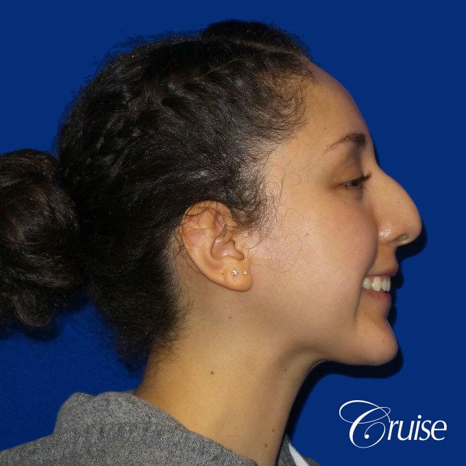 Rhinoplasty - Before and After 3