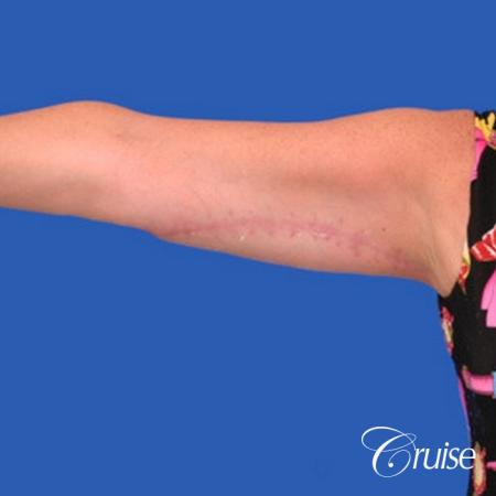 best arm lift newport beach - After Image 2
