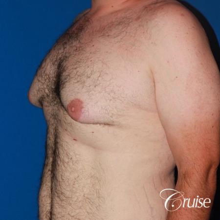 Severe Gynecomastia -Free Nipple Graft - Before Image 2