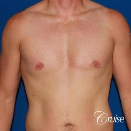 puffy nipple on low body fat - After Image 1