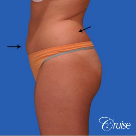 best liposuction results on abdomen, flanks, thighs - Before and After Image 3