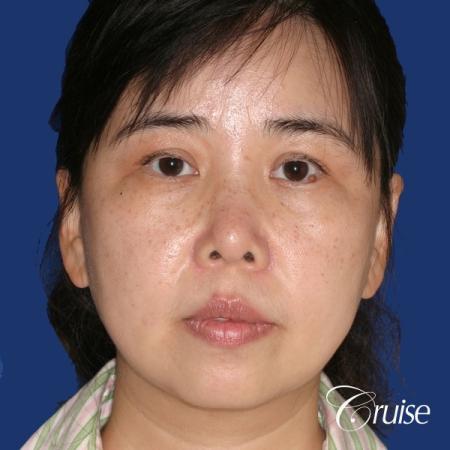 best chin implant photos with large implant - Before Image 1