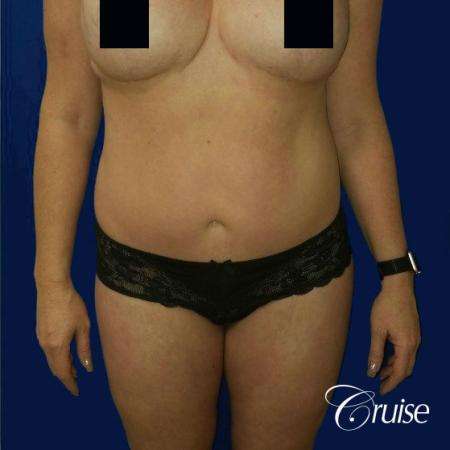 Best tummy tucks dr cruise - After Image 1