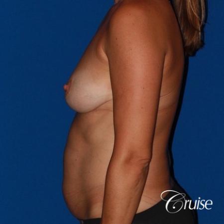 Mommy Makeover: Patient 10 - Before Image 2
