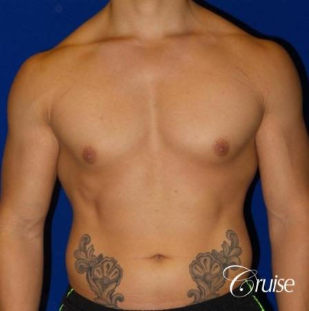Body Builder Gynecomastia -Areola Incision - Before Image 1