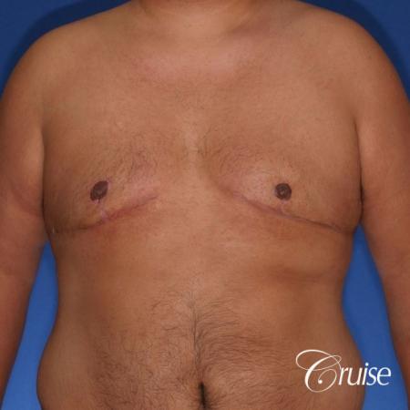 free nipple graft gynecomastia results - After Image 1