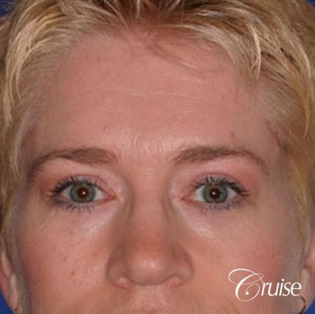 best specialist for upper eyelid surgery - After Image 1