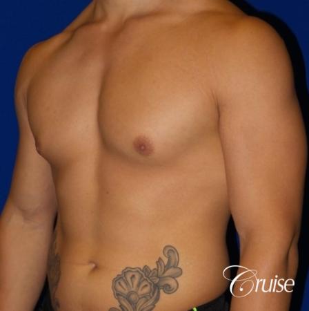 Body Builder Gynecomastia -Areola Incision - Before and After Image 2