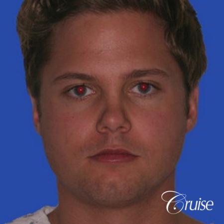 young male with best chin augmentation - Before Image 1
