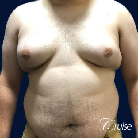 male breast reduction surgery orange county - Before 1