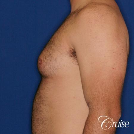 male patient has mild gynecomastia - Before and After Image 2