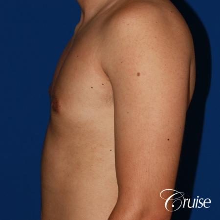 mild gynecomastia before and after with puffy nipple - After Image 2