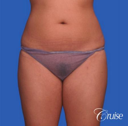 best before and after liposuction stomach and love handles - Before Image