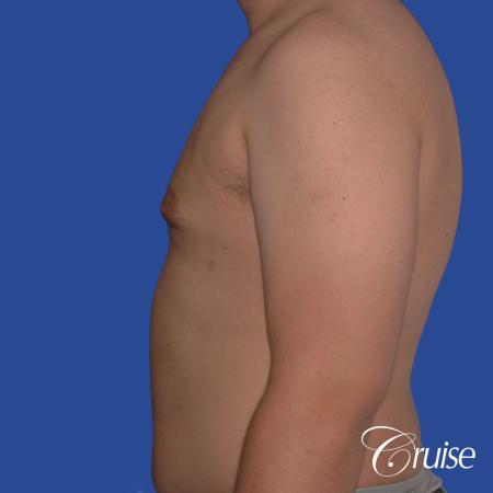 best scars for moderate gynecomastia - After Image 2