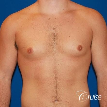athletic adult with puffy nipple - Before Image 1