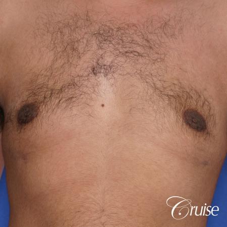 best scar on 32 gynecomastia patient - After Image 1