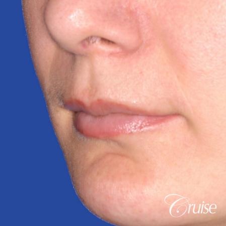 best before and after of lip filler - Before Image 2