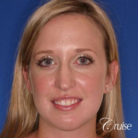 best plastic surgeon for chin augmentation implant - After Image 1