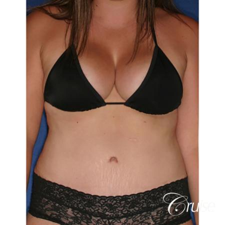 best mommy makeover with saline breast implants - After Image 5