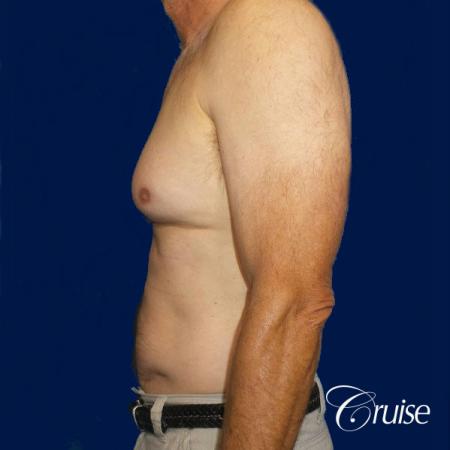 Moderate Gynecomastia Pedicle - Before Image 2
