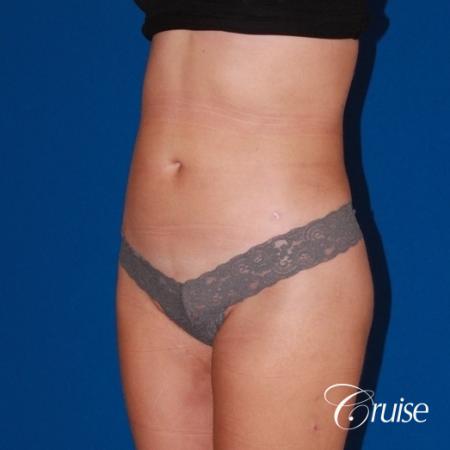 liposuction love handles and tummy - After Image 2