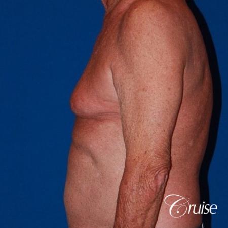 free nipple graft gynecomastia on old man - Before Image 3