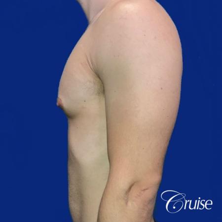 gynecomastia correction newport beach - Before 2