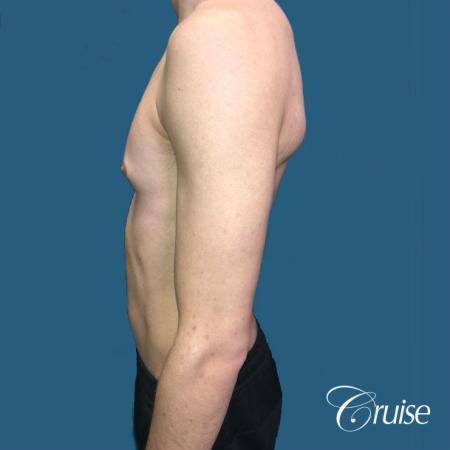 Top Gynecomastia Specialist Dr. Cruise - Before Image 2