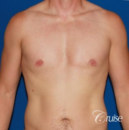 puffy nipple on 35 yr old male - After Image 1