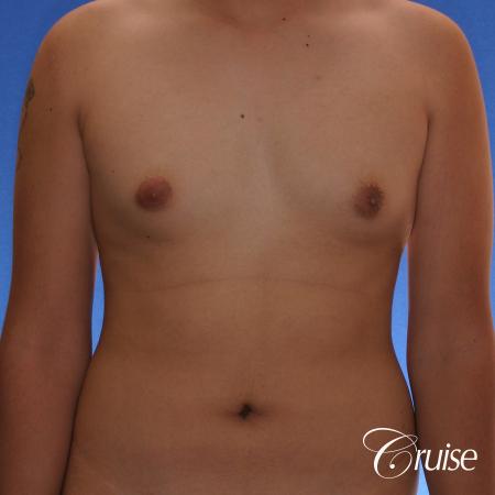 best gynecomastia surgery with plastic surgeon, Dr. Cruise - Before Image 1