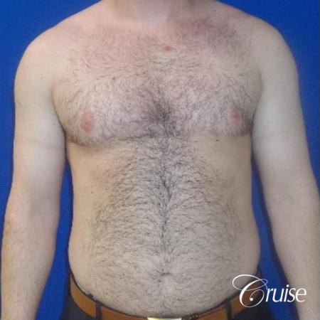 Severe Gynecomastia- Free nipple Graft - After Image 1