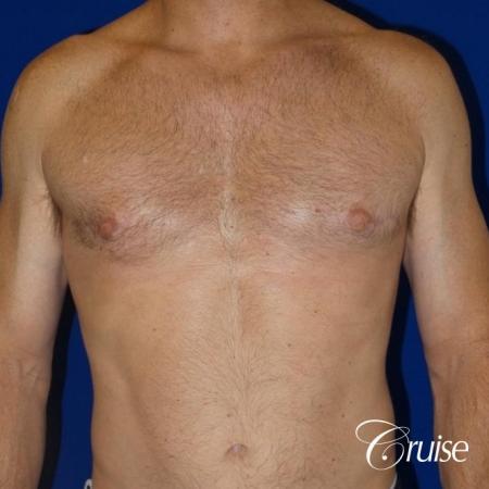 best gynecomastia results on 45 year old - After Image 1