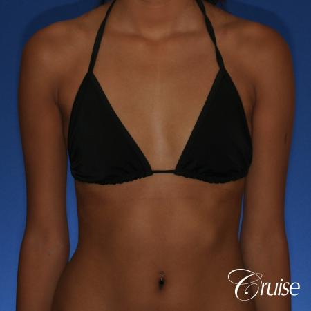 Breast Augmentation - Before and After Image 3