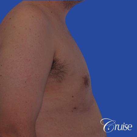 moderate gyne on young male adult - After Image 3