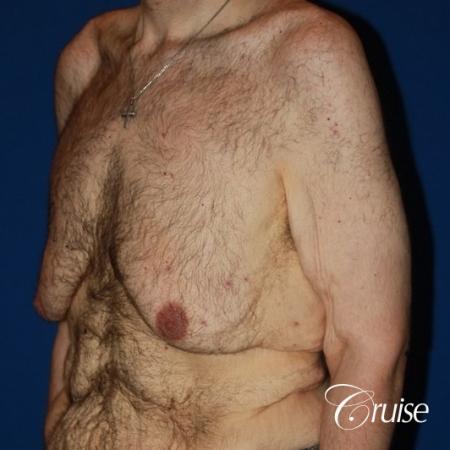 severe weight loss gynecomastia upper body lift - Before Image 2