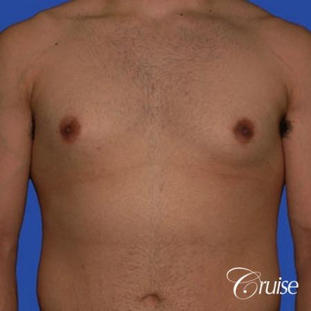 minor gyne young adult with best scars - Before Image 1