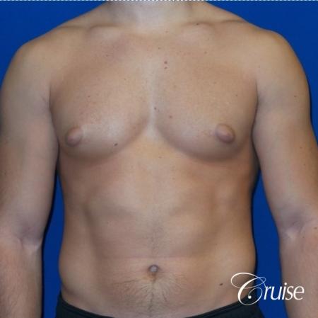 male breast reduction surgery newport beach - Before Image 1