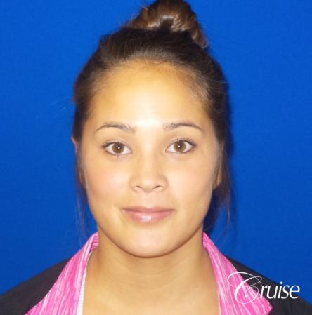 Otoplasty - After Image 1