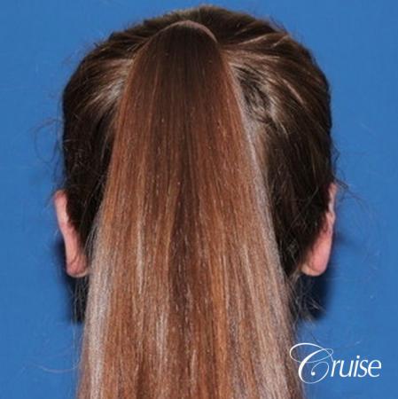 best adult otoplasty on women - After Image 2