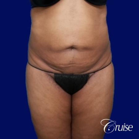 Liposuction Flanks - Before Image 1
