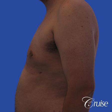 moderate gyne on young male adult - After Image 2