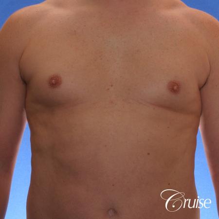 male adult with gynecomastia - Before Image 1