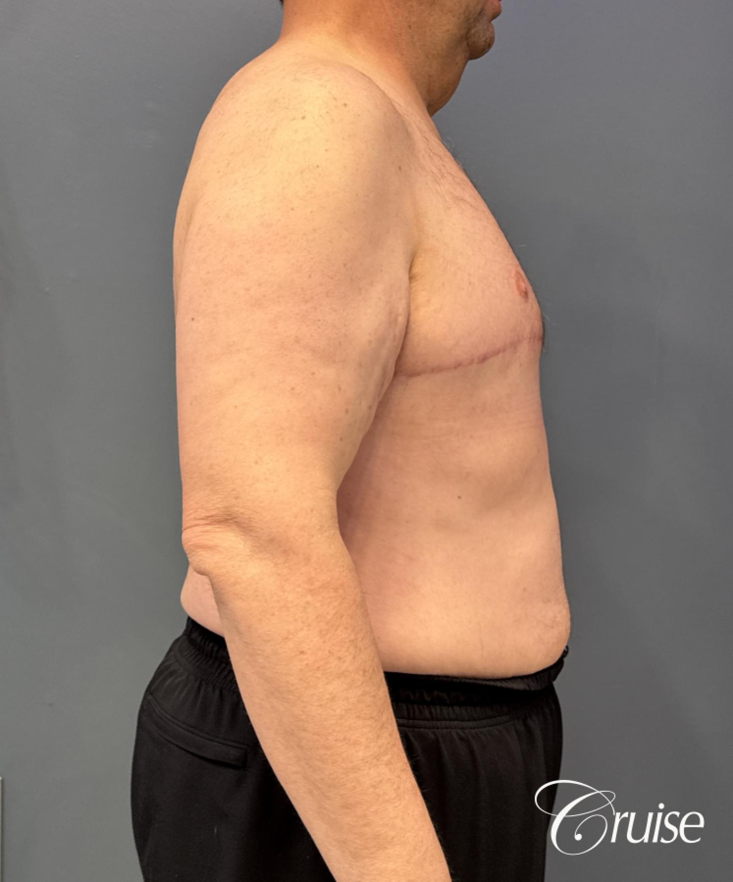 Gynecomastia Type 6; Circumferential Upper Body Lift; Liposuction to Upper Abdominal Rib Fat, Posterior Arms, Upper Back and Flanks - After 2