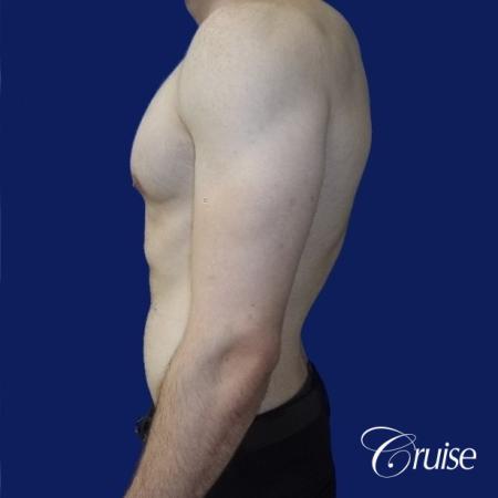 Moderate Gynecomastia -Areola Incision - After Image 2