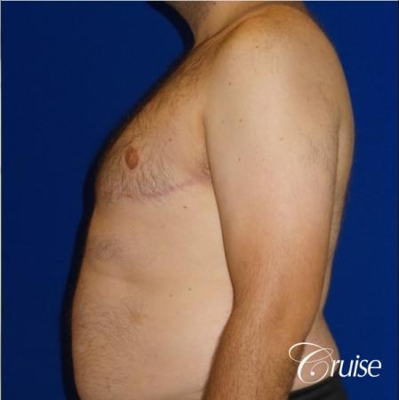 Severe Gynecomastia- Free nipple Graft - After Image 3